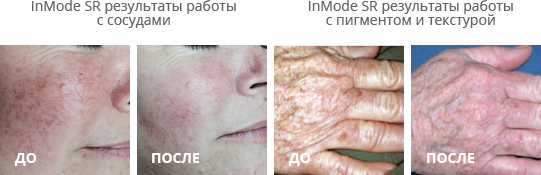 Эффект процедуры IPL - омоложения