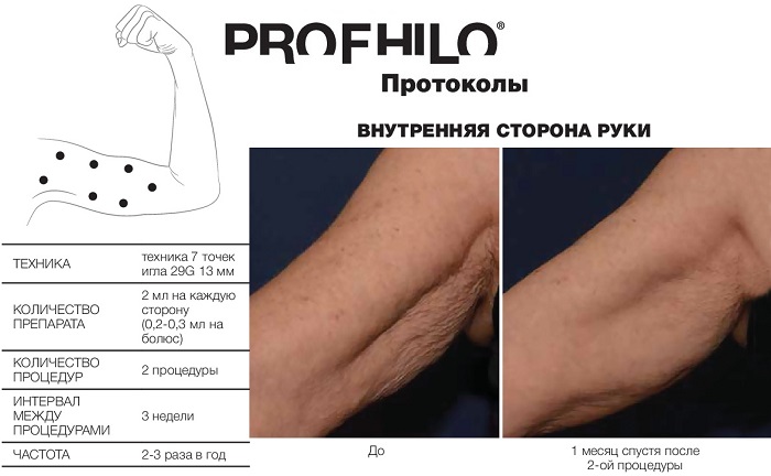Биоревитализация Profhilo внутренней стороны рук