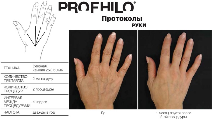 Биоревитализация Profhilo рук