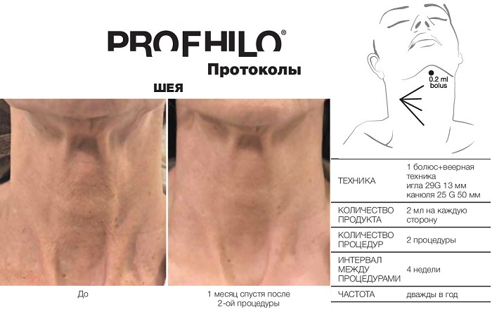 Биоревитализация Profhilo шеи