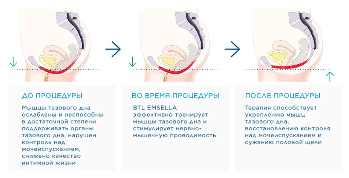 Принцип работы кресла Кегеля Эмселла