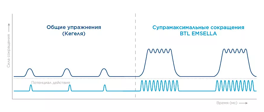 График: сравнение упражнений Кегеля и воздействия кресла Emsella